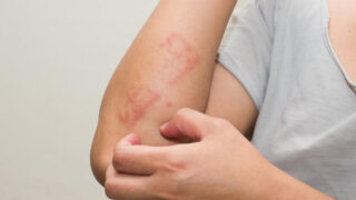 Allergy