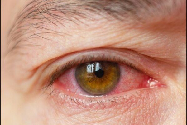 فضائی آلودگی، مستقل نابینا پن کی وجہ بن سکتی ہے