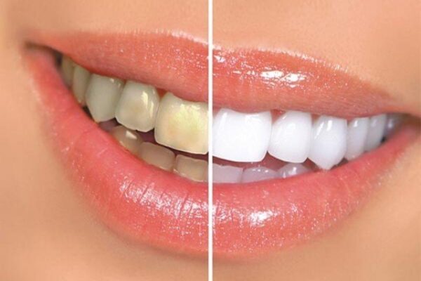 دانتوں کی صفائی ضروری ہے… لیکن کب؟