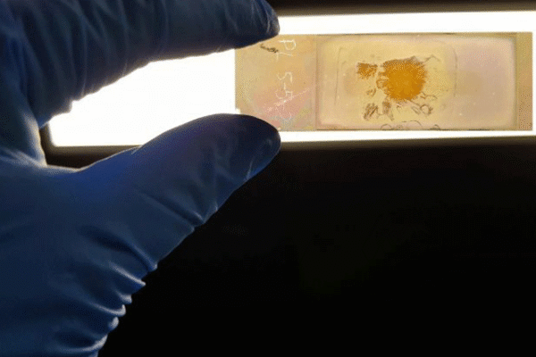 رنگ بدل کر امراض شناخت کرنے والی نینوٹیک پٹی