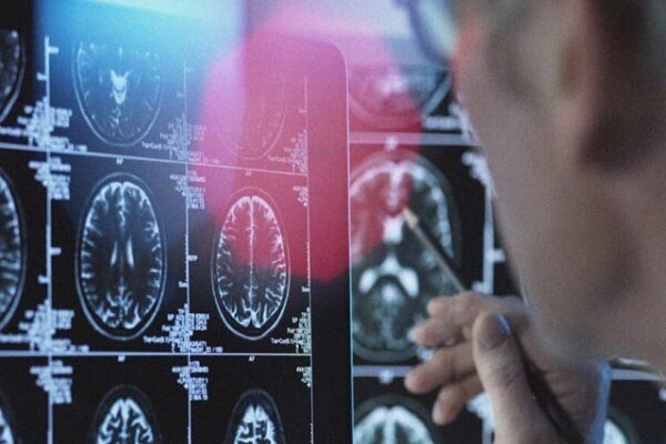 مرگی میں مبتلا افراد کے دماغ جلد ‘بوڑھے’ ہو جاتے ہیں، ماہرین