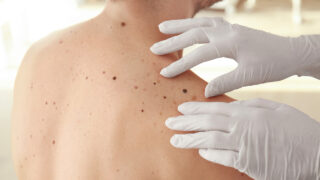 uv-rays-cause-80-percent-skin-cancers