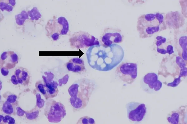 سندھ میں دماغ کھانے والے امیبا سے پانچویں ہلاکت، کراچی کا نوجوان چل بسا