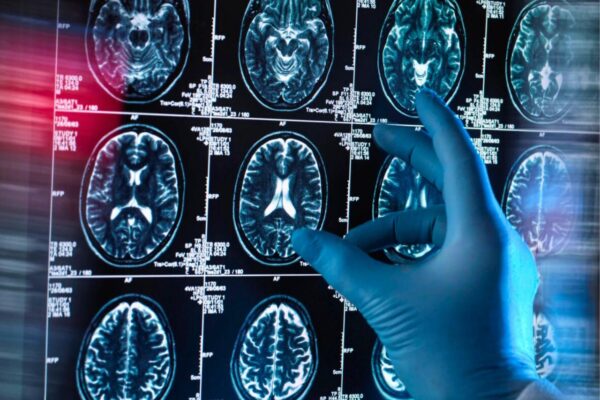 گہری نیند: الزائمر کے خلاف دماغی ڈھال کا نیا سائنسی انکشاف