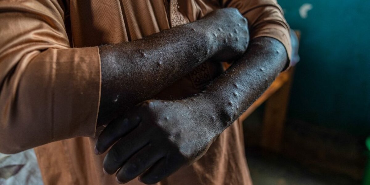 Two New Mpox Cases Detected on Réunion Island