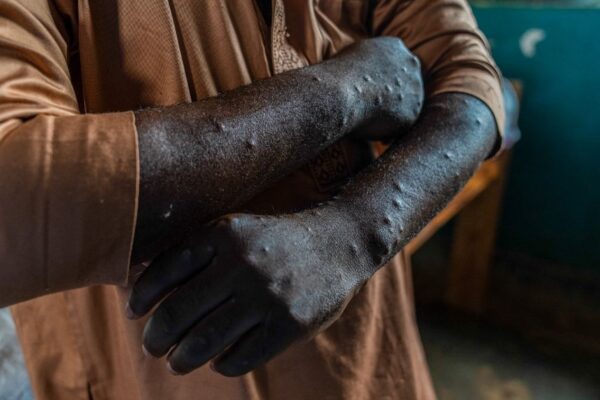 ری یونین میں مپاکس کے دو نئے کیسز رپورٹ، احتیاطی ویکسینیشن مہم کا آغاز