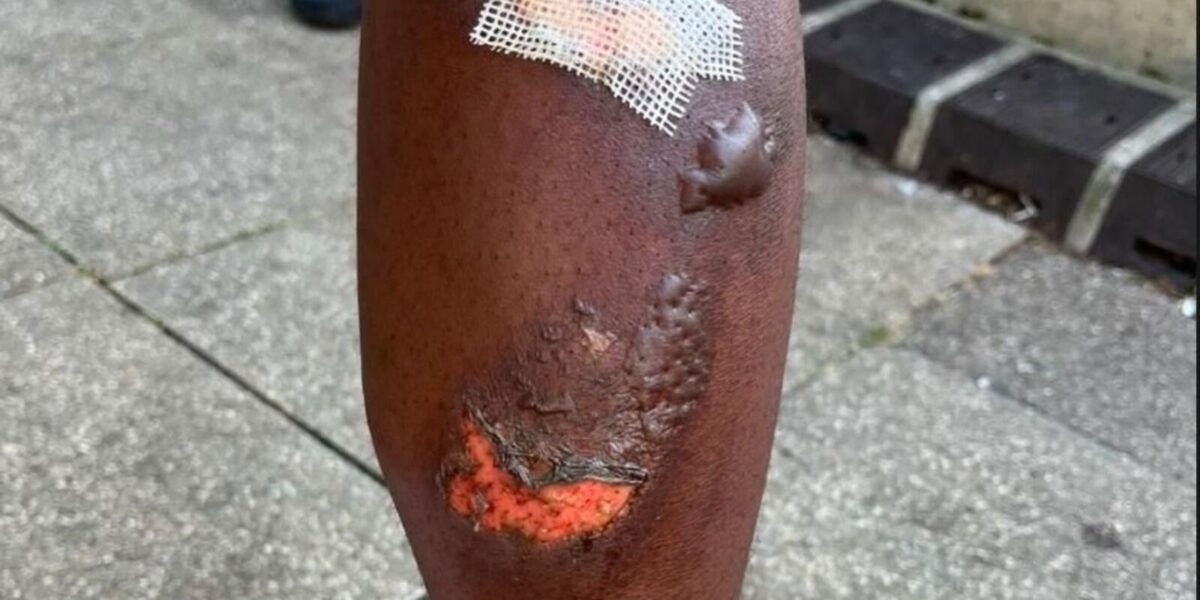 Teen Burned by Exhaust: Police Brutality Claim in Noisy-le-Grand