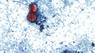 FDA Closes Investigation into "Explosive Diarrhea" Outbreak, Traces Parasite to Mexican Lettuce Operations